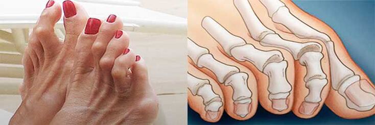 Mallet toe deformity