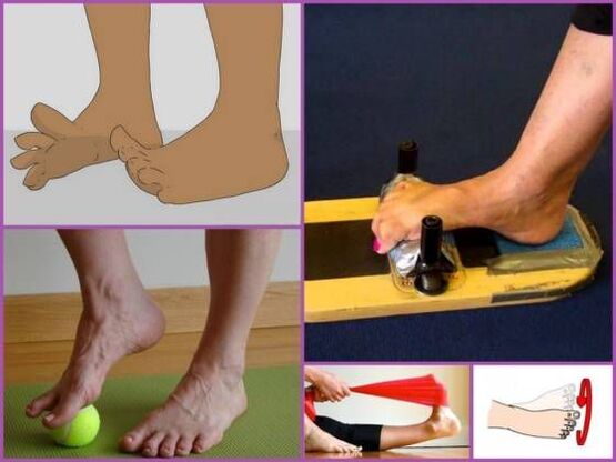 Physical therapy for planovalgus foot deformity