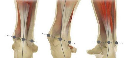 The norm of the foot axis and its curvature in case of plano-valgus deformity