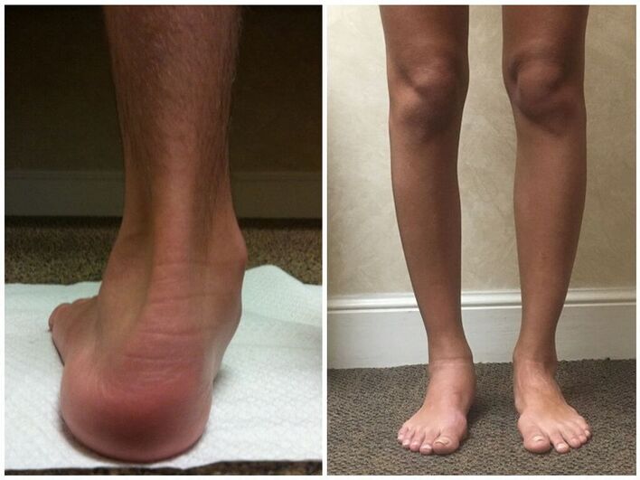 Legs with hallux valgus