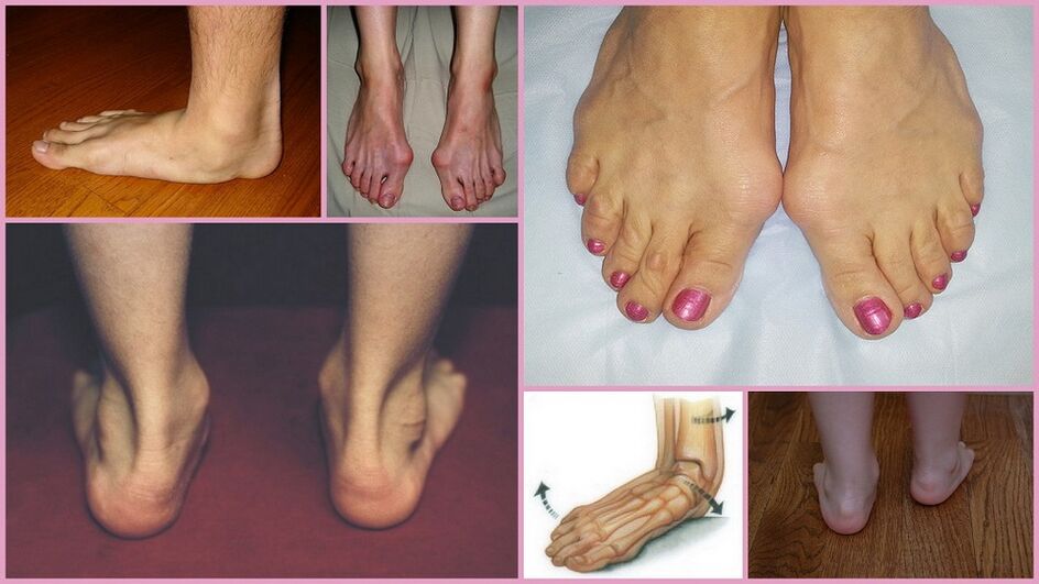 Manifestations of valgus foot in adults