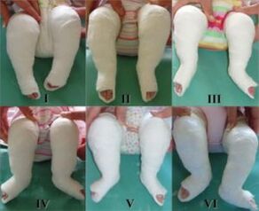 Plastering procedures, each of which changes the position of the foot