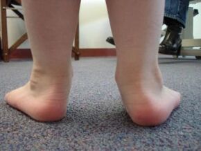 Valgus flatfoot deformity in a child