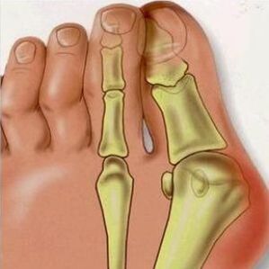 The reasons of Valgus