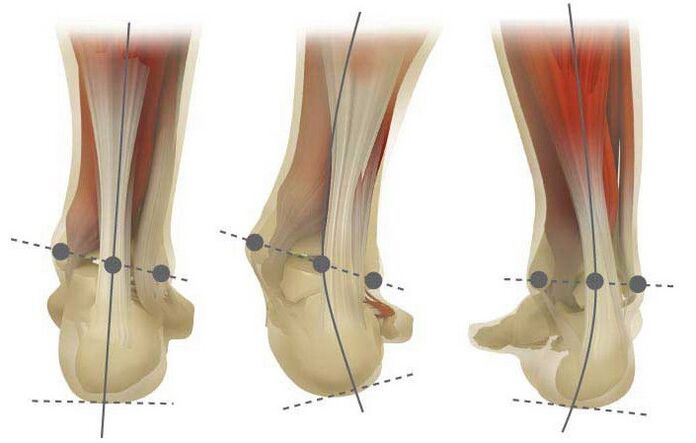 Types of valgus