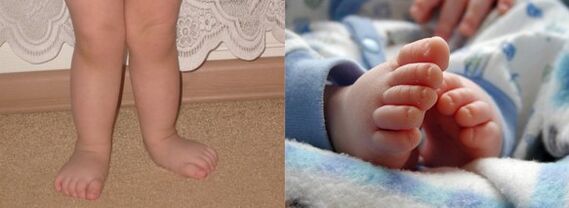 Foot deformation valgus