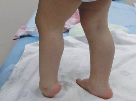 The first symptoms of the Valgus del Pieda deformation