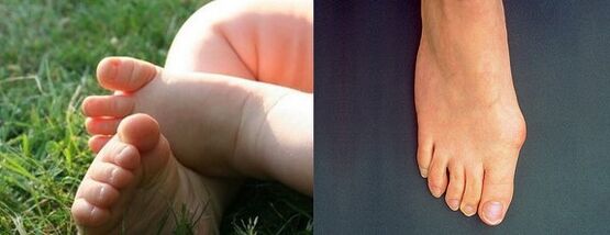 Valgus deformation of the first finger of the foot