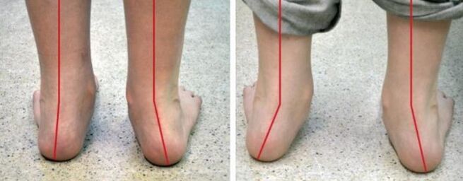 Valgus foot