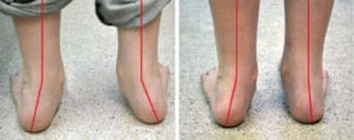 Valgus Curvatures